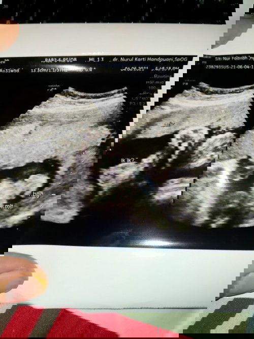 Bertanya bgaimana membaca USG