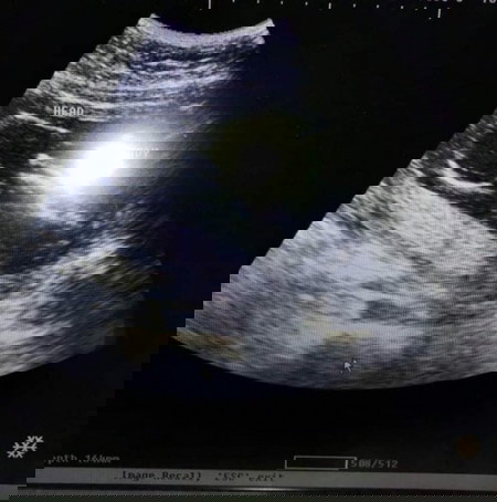 20 weeks pregnant.My baby is not moving and does not detect heart beat in ultrasound monitor.