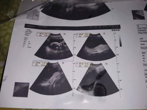 น้องมีปันหาเรื่องปอด