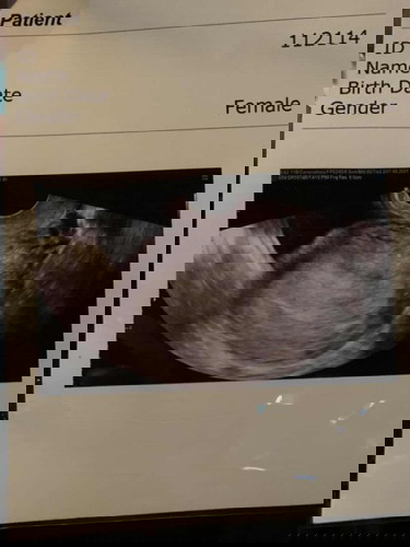 6wไม่เจอถุงตั้งครรภ์หมอกลัวท้องนอกมลลูกมีแม่ๆคนไหนเป็นแบบนี้มั้ยค่ะ