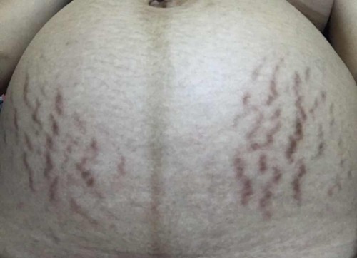 หน้าท้องแตกลาย