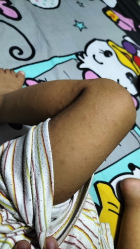 ลูกเป็นผื่น