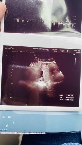 แม่ๆแพ้ท้องกันขนาดไหน และมีวิธีรับมือกับอาการยังไงบ้างค่ะ