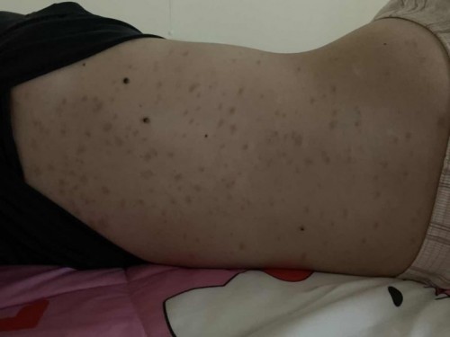 ผื่นขึ้นเยอะมาก