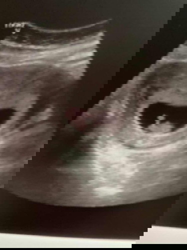 8minggu scan tak dapat cari lilitan kepala janin normal ke?