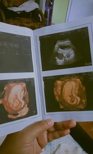 Ada yg pernah ngalamin ga bund? Ketika lagi hamil pas di usg terdapat kista:( bahaya gak buat janin?