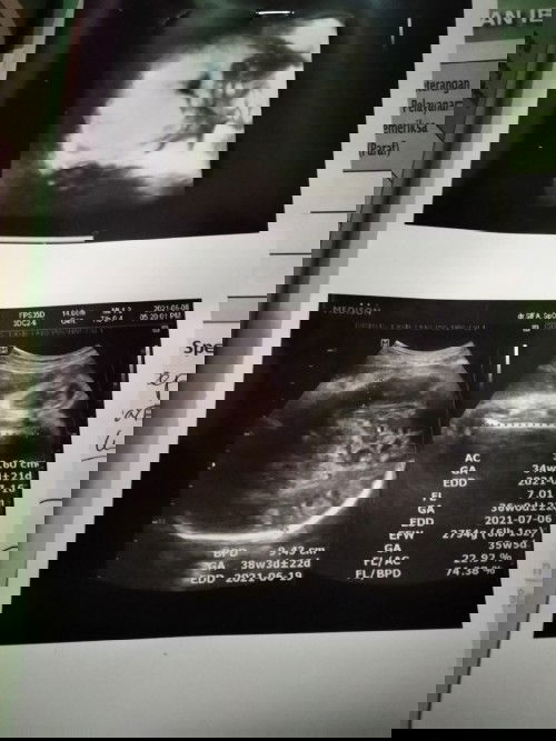 ukuran kepala 38 minggu. 9,4 cm