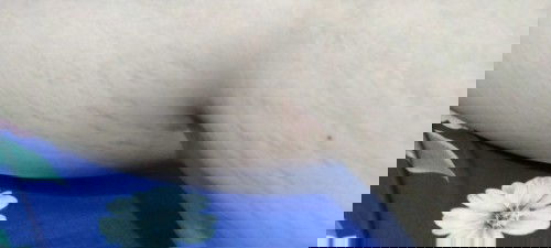 Thuốc trị rạn hiệu quả