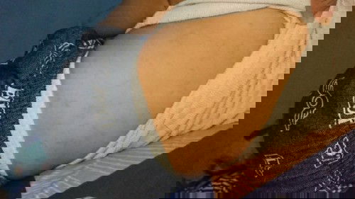 Kulit bintik2 setelah demam