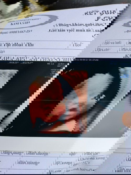 Tướng ngủ há miệng trong bụng mẹ