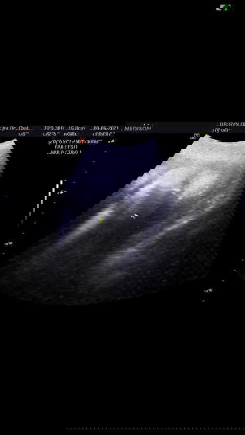 สวัสดีค่ะ. ขอสอบถามแม่ๆ. เรื่อง. น้ำหนักลูก ค่ะ. พอดีตอนนี้ ตั้งครรภ์ได้ 32สัปดาห์แล้ว. นน.ควรจะอยู่กี่กรัมค่ะถึงจะปกติ