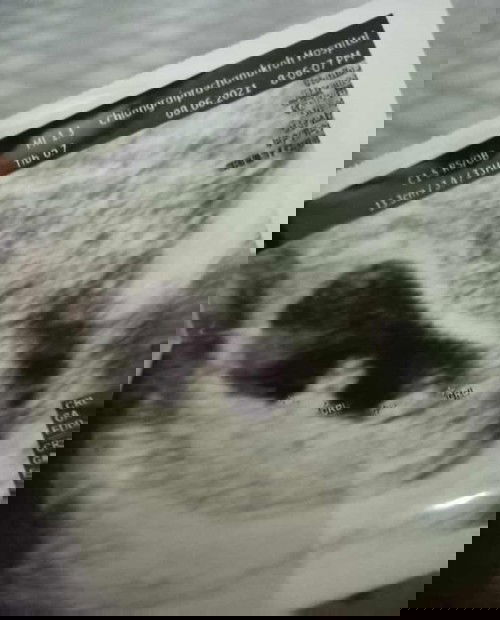 #ท้องแฝดจริงหรือไม่จริง