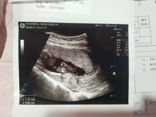 ใครมองออกบ้างมั้ยค้ะว่าหัวอยู่ตรงไหน
แร้ว ผญ.หรือ ผช. 16 w แร้วค่ะ