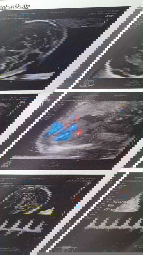 Con mình được 23w đi khám bị dị dạng động mạch chủ, động mạch co giãn và ngoằn ngèo. Mình lo quá