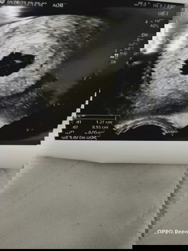 อายุครรภ์5week