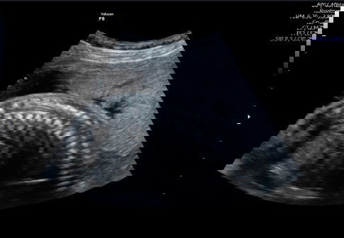 USG 24W PLASENTA MENDEKATI OUI