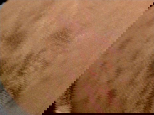 แม่ๆมีวิธีลดรอยแตกมั้ยคะคือบ้านนี้รอยแตกมันดำมากเลยไม่รู้จะทำยังไงให้หายหรือจางหรือครีมตัวไหนแนะนำ