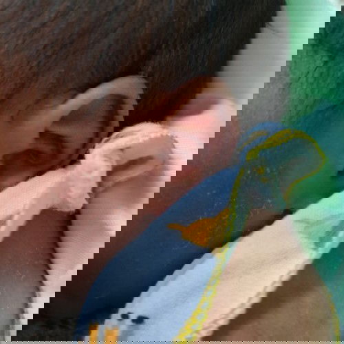 Kulit bayi mengelupas