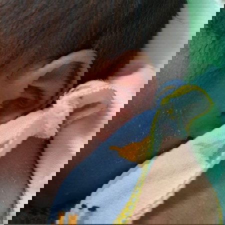 Kulit bayi mengelupas