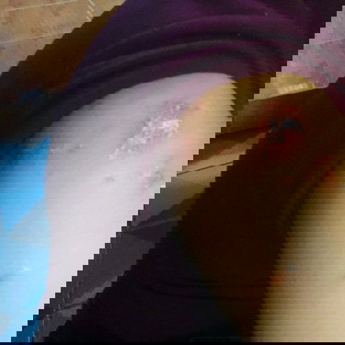 แม่ๆอยากทราบว่าแม่ๆคนไหนเป็นแบบนี้ไหมค้ะ มีผื่นแดงๆขึ้น ไม่รุ้ว่าแพ้อะไรหรือป่าวค้ะ  ตั้งแต่กินยาที่หมอไห้มา