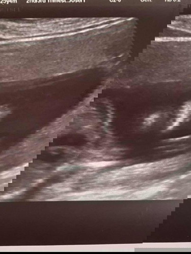 20 weeks ultrasound