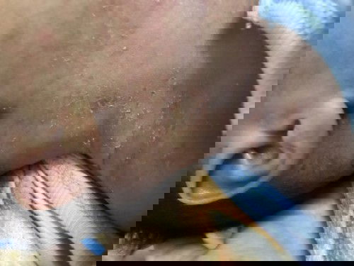 Các mom cho e hỏi con em 20 ngày tuổi bị ntn có phải bị bong da không ạ làm ntn để hết đó cho e xin ý kiến ạ