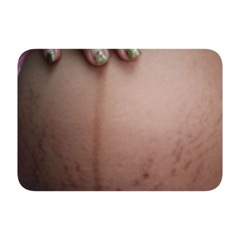 ใครท้องลายแบบนี้บ้าง