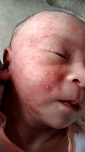 ผื่นขึ้นบนหัว หน้าเเละคอน้อง เป็นอะไรเเละต้องทำอย่างไรคะเเม่ๆ