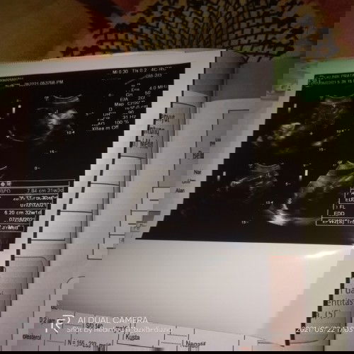 Kenapa hpl bidan dan hasil USG beda y???