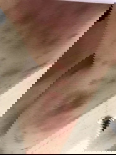 ผื่นขณะตั้งครรภ์ PUPPP หมอให้ยา TA cream lotion