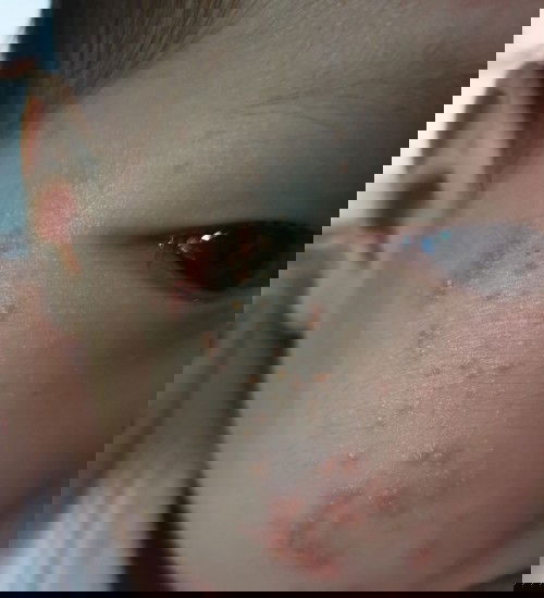 ผื่นแบบนี้ คืนผื่นอะไรคับ ควรรักษาอย่างไร