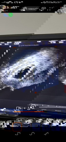 แฝด3 จาก icsi ตอนนี้ เหลือแค่ 1