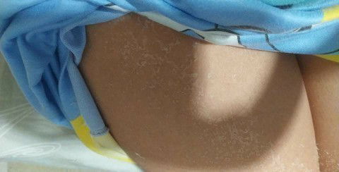 Pangangati at Pamamalat