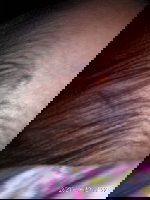 Obat bentol atau melinting pada bayi ada yg tau ga bun