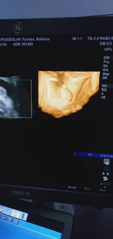 Tanya soal jenis kelamin di usia 34 week