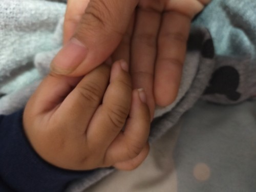 Kulit bayi menghitam dan belang