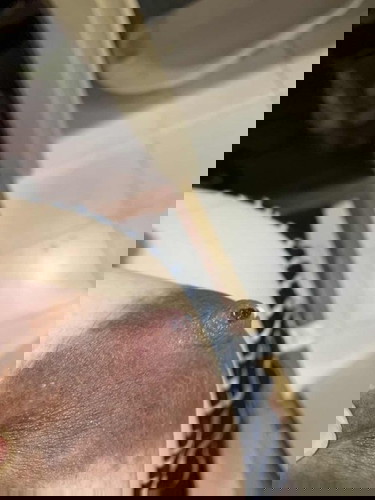 หัวนมเป็นตุ่มพอง (ห้อเลือด) !!!!!