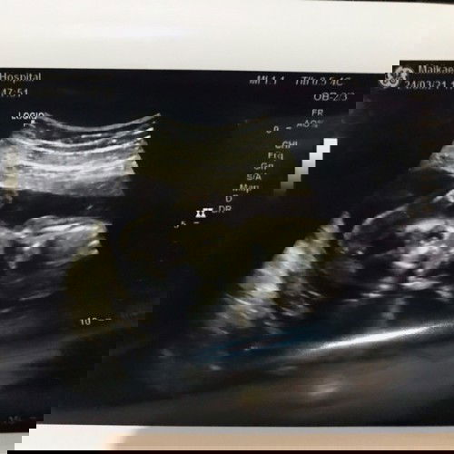 ประสบการณ์ว่าทีคุณแม่ลูกแฝด