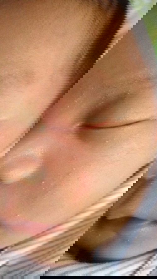 Bintik merah pada bayi