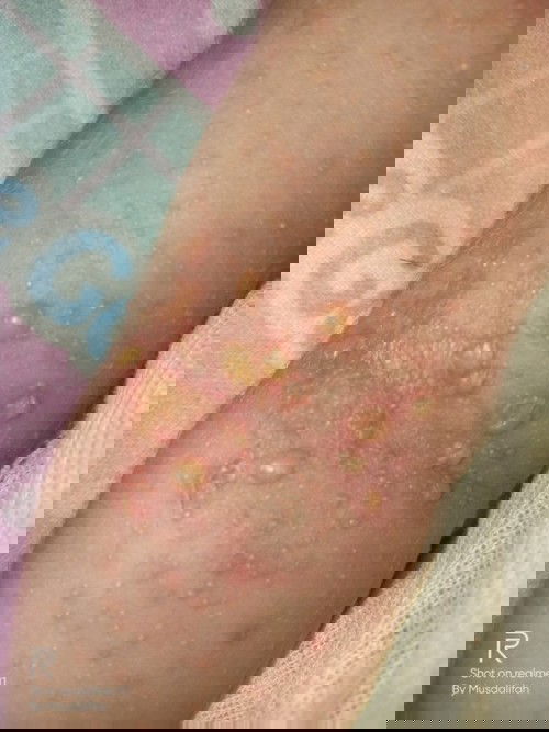 bayi usia 1weeks ada bintik-bintik putih di tangan, leher, jidat itu obatnya apa?