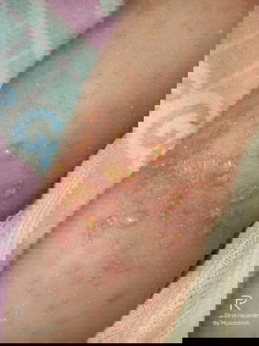 bayi usia 1weeks ada bintik-bintik putih di tangan, leher, jidat itu obatnya apa?