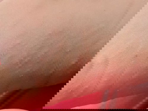 Bintik bintik merah dan berair