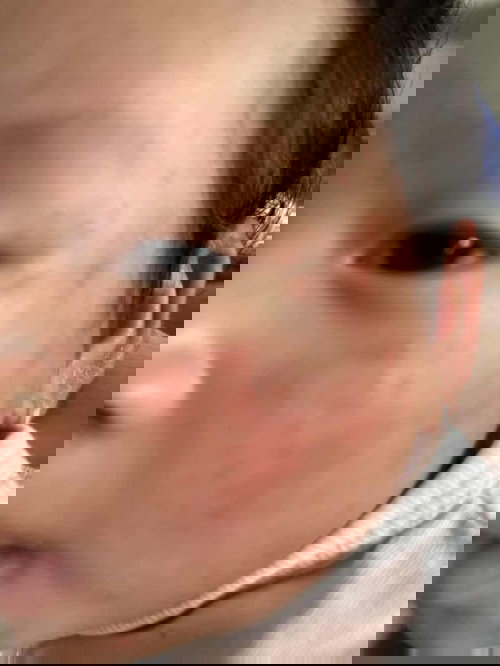 Da mẩn đỏ nổi hột