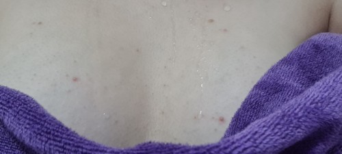 Pimples? On boobs