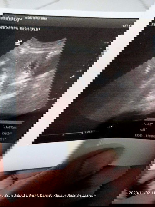 Hpl tgl 16 juni, usg terakhir dokter bilng  tnggl nunggu hari, mulesny bentar trus ilang, ada yg sma