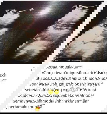 Posisi Debay hasil USg