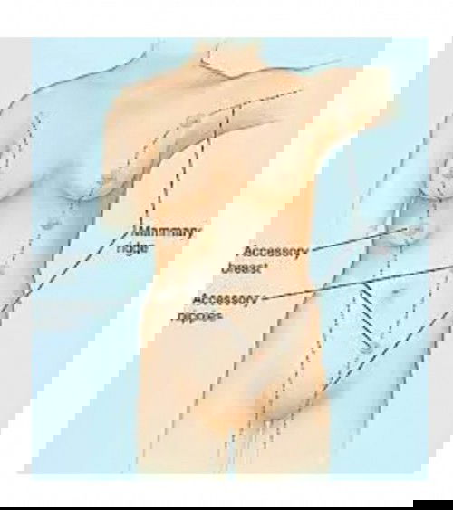 นมส่วนเกิน ไขมันส่วนเกิน ก้อนเนื้อใต้รักแร้