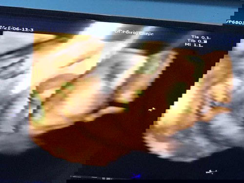 อัลตราซาวด์ 27w6d