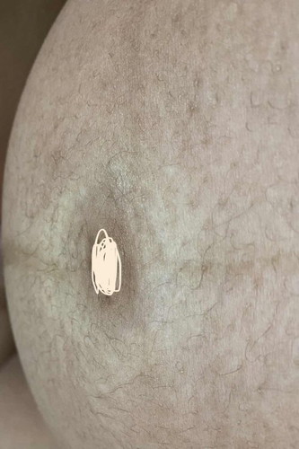 รอบสะดือมีสีขาว