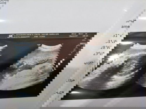 Alam nyo po ba basahin ang ultrasound pic na 'to? Sabi sa amin BOY daw 😊